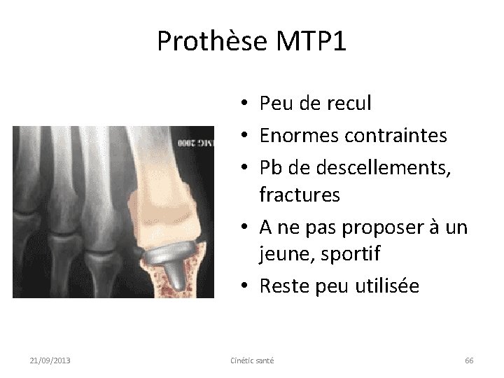Prothèse MTP 1 • Peu de recul • Enormes contraintes • Pb de descellements,