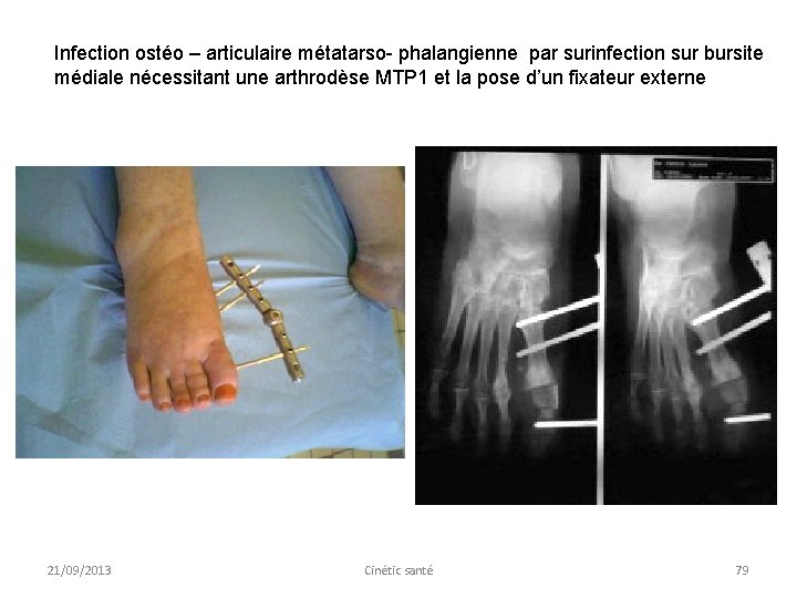 Infection ostéo – articulaire métatarso- phalangienne par surinfection sur bursite médiale nécessitant une arthrodèse