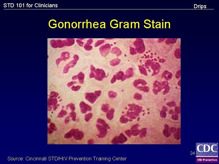 STD 101 for Clinicians Drips Gonorrhea Gram Stain 24 Source: Cincinnati STD/HIV Prevention Training