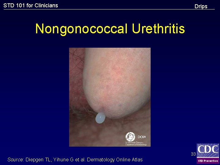 STD 101 for Clinicians Drips Nongonococcal Urethritis 33 Source: Diepgen TL, Yihune G et
