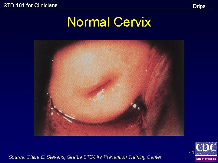STD 101 for Clinicians Drips Normal Cervix Source: Claire E. Stevens, Seattle STD/HIV Prevention