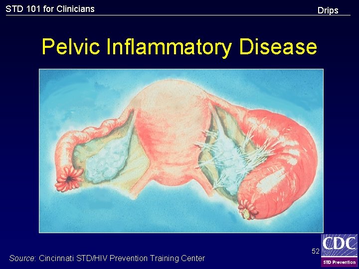 STD 101 for Clinicians Drips Pelvic Inflammatory Disease Source: Cincinnati STD/HIV Prevention Training Center