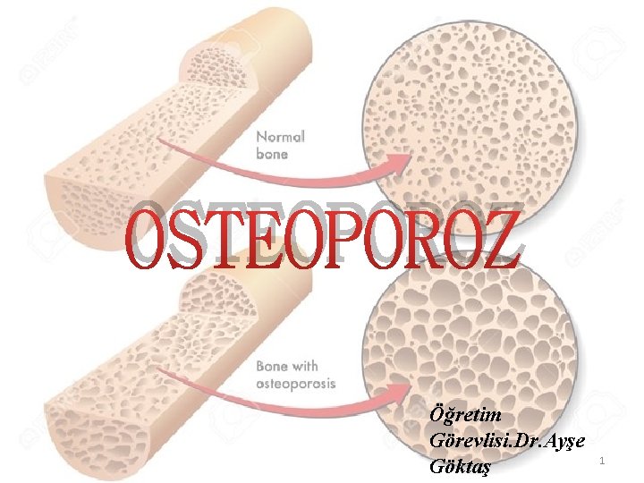 OSTEOPOROZ Öğretim Görevlisi. Dr. Ayşe Göktaş 1 