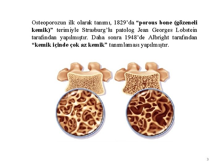 Osteoporozun ilk olarak tanımı, 1829’da “porous bone (gözeneli kemik)” terimiyle Strasburg’lu patolog Jean Georges