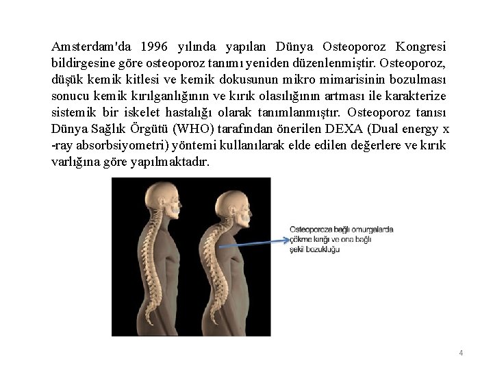 Amsterdam'da 1996 yılında yapılan Dünya Osteoporoz Kongresi bildirgesine göre osteoporoz tanımı yeniden düzenlenmiştir. Osteoporoz,