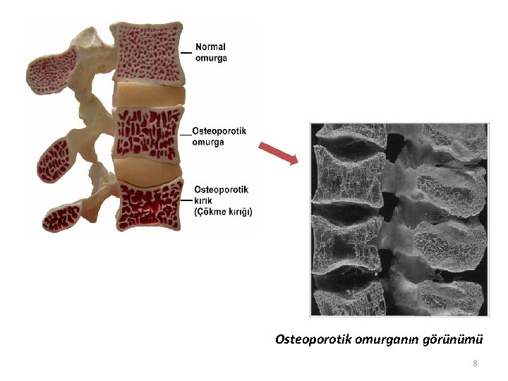 Osteoporotik omurganın görünümü 8 