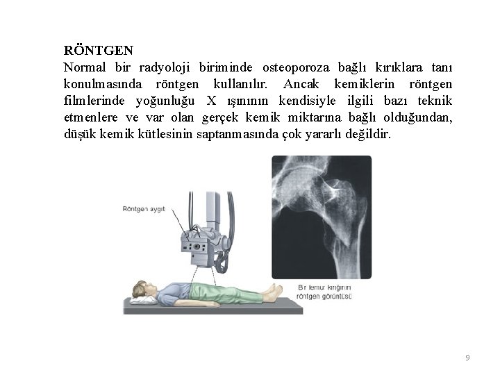 RÖNTGEN Normal bir radyoloji biriminde osteoporoza bağlı kırıklara tanı konulmasında röntgen kullanılır. Ancak kemiklerin