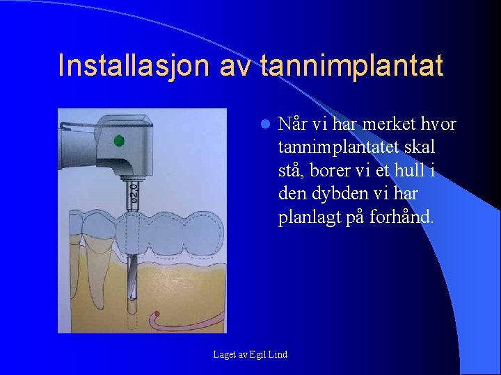 Installasjon av tannimplantat l Når vi har merket hvor tannimplantatet skal stå, borer vi Installasjon av tannimplantat l Når vi har merket hvor tannimplantatet skal stå, borer vi