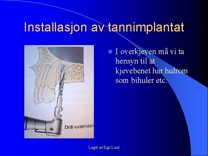 Installasjon av tannimplantat l I overkjeven må vi ta hensyn til at kjevebenet har Installasjon av tannimplantat l I overkjeven må vi ta hensyn til at kjevebenet har