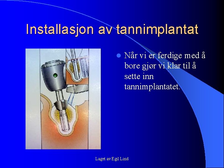 Installasjon av tannimplantat l Når vi er ferdige med å bore gjør vi klar Installasjon av tannimplantat l Når vi er ferdige med å bore gjør vi klar