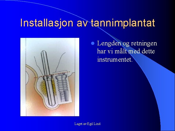 Installasjon av tannimplantat l Lengden og retningen har vi målt med dette instrumentet. Laget Installasjon av tannimplantat l Lengden og retningen har vi målt med dette instrumentet. Laget
