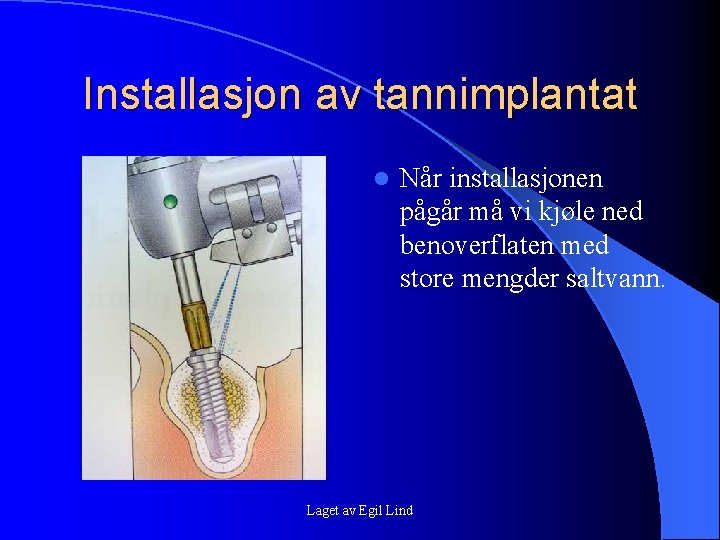 Installasjon av tannimplantat l Når installasjonen pågår må vi kjøle ned benoverflaten med store Installasjon av tannimplantat l Når installasjonen pågår må vi kjøle ned benoverflaten med store