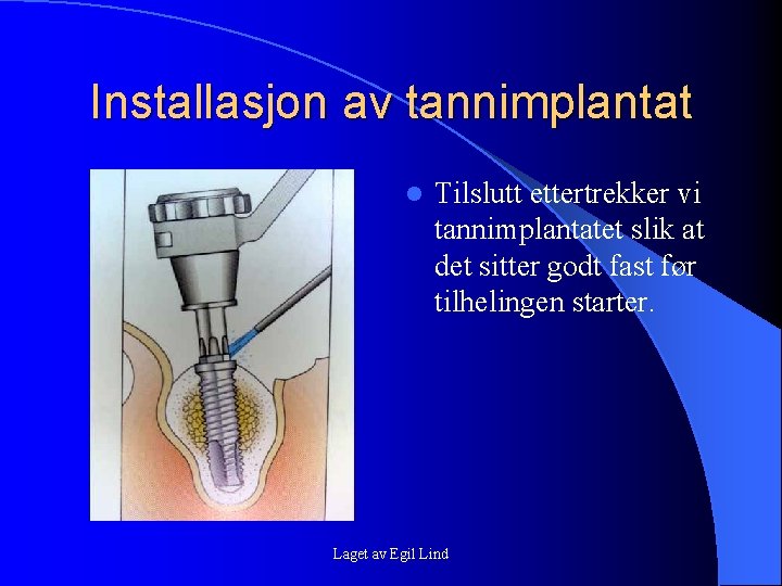 Installasjon av tannimplantat l Tilslutt ettertrekker vi tannimplantatet slik at det sitter godt fast Installasjon av tannimplantat l Tilslutt ettertrekker vi tannimplantatet slik at det sitter godt fast