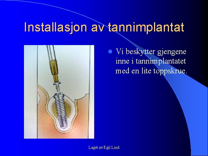 Installasjon av tannimplantat l Vi beskytter gjengene inne i tannimplantatet med en lite toppskrue. Installasjon av tannimplantat l Vi beskytter gjengene inne i tannimplantatet med en lite toppskrue.
