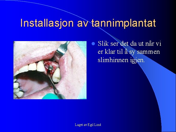 Installasjon av tannimplantat l Slik ser det da ut når vi er klar til Installasjon av tannimplantat l Slik ser det da ut når vi er klar til