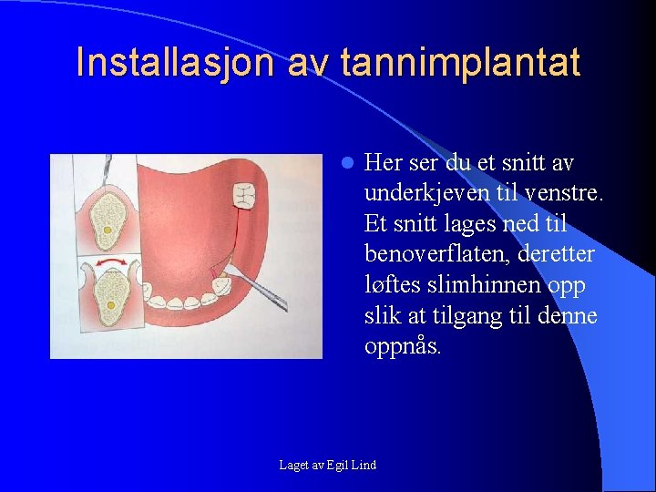 Installasjon av tannimplantat l Her ser du et snitt av underkjeven til venstre. Et Installasjon av tannimplantat l Her ser du et snitt av underkjeven til venstre. Et