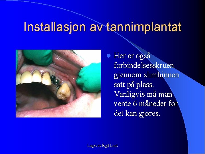 Installasjon av tannimplantat l Her er også forbindelsesskruen gjennom slimhinnen satt på plass. Vanligvis Installasjon av tannimplantat l Her er også forbindelsesskruen gjennom slimhinnen satt på plass. Vanligvis