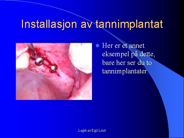 Installasjon av tannimplantat l Her er et annet eksempel på dette, bare her ser Installasjon av tannimplantat l Her er et annet eksempel på dette, bare her ser
