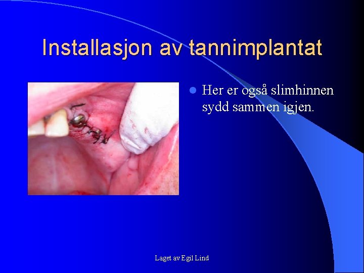 Installasjon av tannimplantat l Her er også slimhinnen sydd sammen igjen. Laget av Egil Installasjon av tannimplantat l Her er også slimhinnen sydd sammen igjen. Laget av Egil