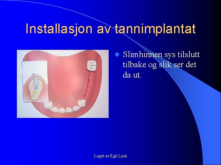 Installasjon av tannimplantat l Slimhinnen sys tilslutt tilbake og slik ser det da ut. Installasjon av tannimplantat l Slimhinnen sys tilslutt tilbake og slik ser det da ut.