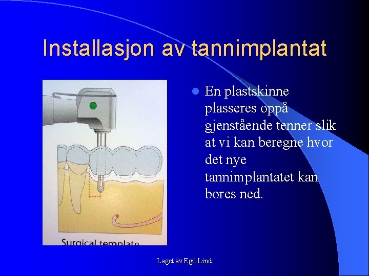 Installasjon av tannimplantat l En plastskinne plasseres oppå gjenstående tenner slik at vi kan Installasjon av tannimplantat l En plastskinne plasseres oppå gjenstående tenner slik at vi kan