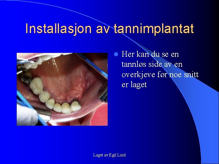 Installasjon av tannimplantat l Her kan du se en tannløs side av en overkjeve Installasjon av tannimplantat l Her kan du se en tannløs side av en overkjeve