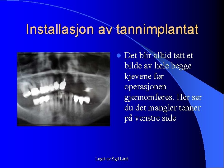 Installasjon av tannimplantat l Det blir alltid tatt et bilde av hele begge kjevene Installasjon av tannimplantat l Det blir alltid tatt et bilde av hele begge kjevene