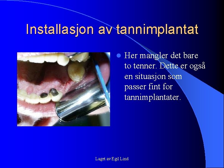 Installasjon av tannimplantat l Her mangler det bare to tenner. Dette er også en Installasjon av tannimplantat l Her mangler det bare to tenner. Dette er også en