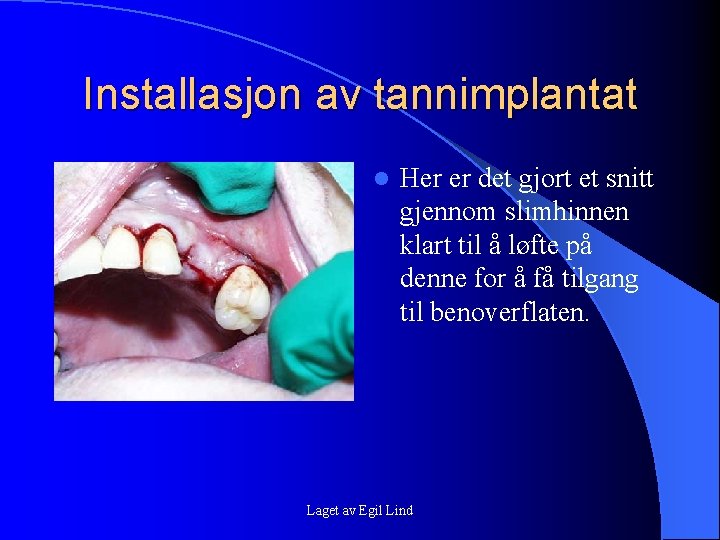 Installasjon av tannimplantat l Her er det gjort et snitt gjennom slimhinnen klart til Installasjon av tannimplantat l Her er det gjort et snitt gjennom slimhinnen klart til