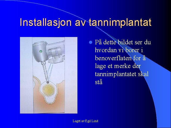 Installasjon av tannimplantat l På dette bildet ser du hvordan vi borer i benoverflaten Installasjon av tannimplantat l På dette bildet ser du hvordan vi borer i benoverflaten