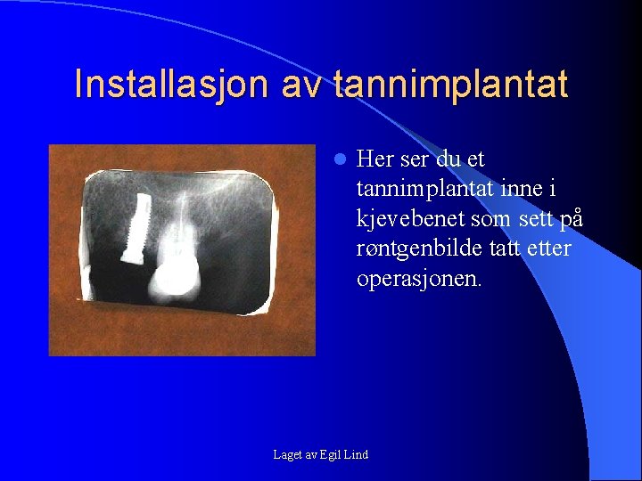 Installasjon av tannimplantat l Her ser du et tannimplantat inne i kjevebenet som sett Installasjon av tannimplantat l Her ser du et tannimplantat inne i kjevebenet som sett