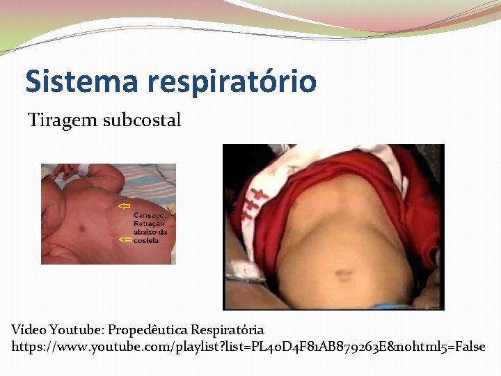 Sistema respiratório Tiragem subcostal Vídeo Youtube: Propedêutica Respiratória https: //www. youtube. com/playlist? list=PL 40