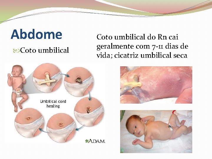 Abdome Coto umbilical do Rn cai geralmente com 7 -11 dias de vida; cicatriz