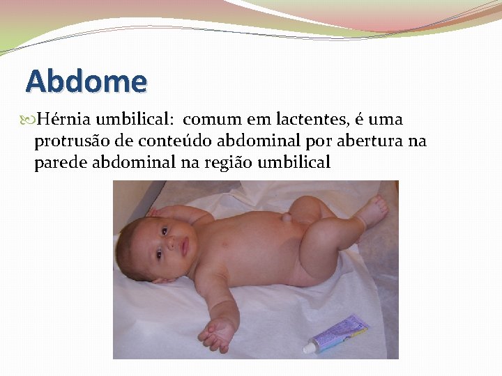 Abdome Hérnia umbilical: comum em lactentes, é uma protrusão de conteúdo abdominal por abertura