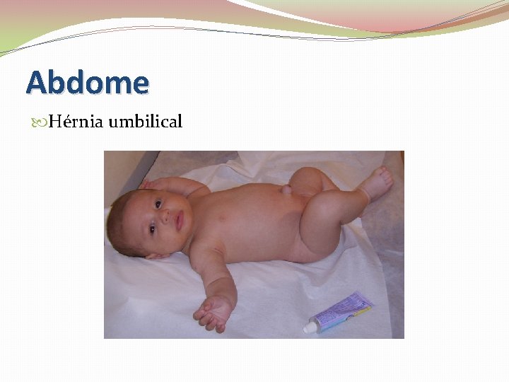 Abdome Hérnia umbilical 