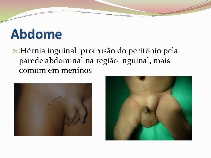 Abdome Hérnia inguinal: protrusão do peritônio pela parede abdominal na região inguinal, mais comum