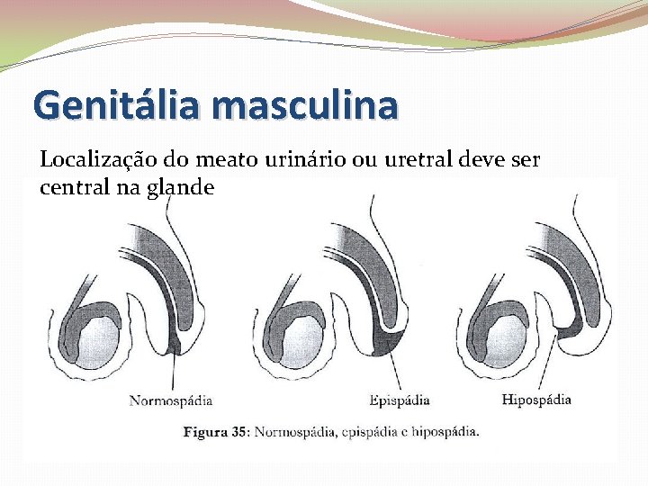 Genitália masculina Localização do meato urinário ou uretral deve ser central na glande 