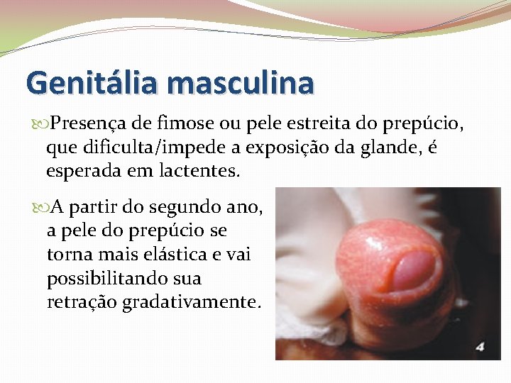 Genitália masculina Presença de fimose ou pele estreita do prepúcio, que dificulta/impede a exposição