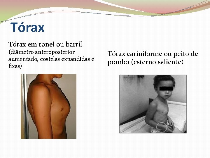 Tórax em tonel ou barril (diâmetro anteroposterior aumentado, costelas expandidas e fixas) Tórax cariniforme