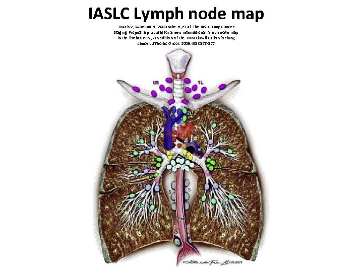 IASLC Lymph node map Rusch V, Asamura H, Watanabe H, et al. The IASLC