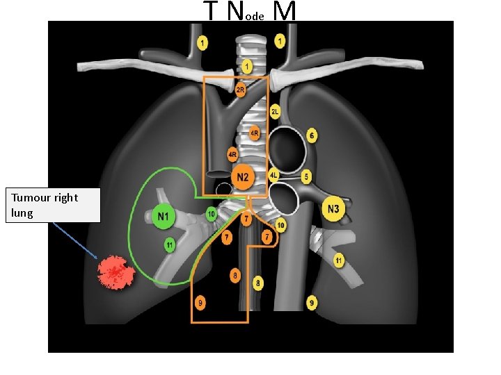 T Node M Tumour right lung 