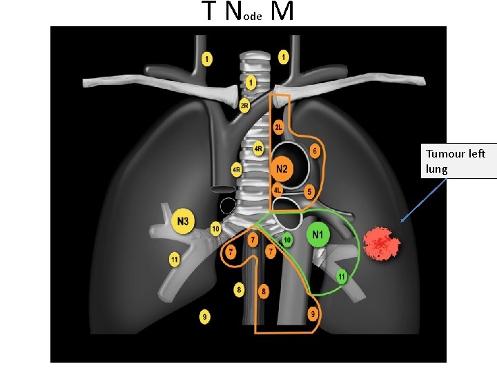 T Node M Tumour left lung 