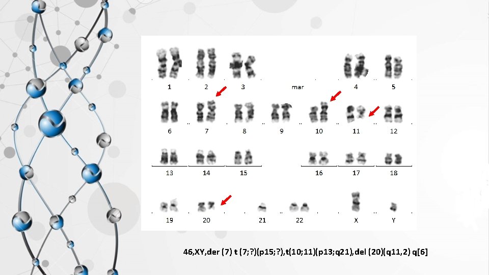46, XY, der (7) t (7; ? )(p 15; ? ), t(10; 11)(p 13;