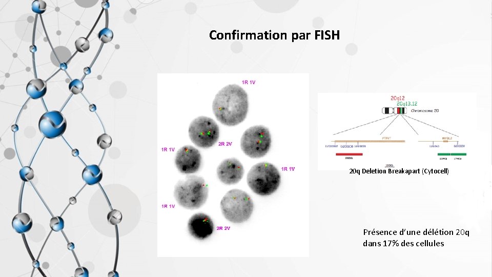 Confirmation par FISH 20 q Deletion Breakapart (Cytocell) Présence d’une délétion 20 q dans