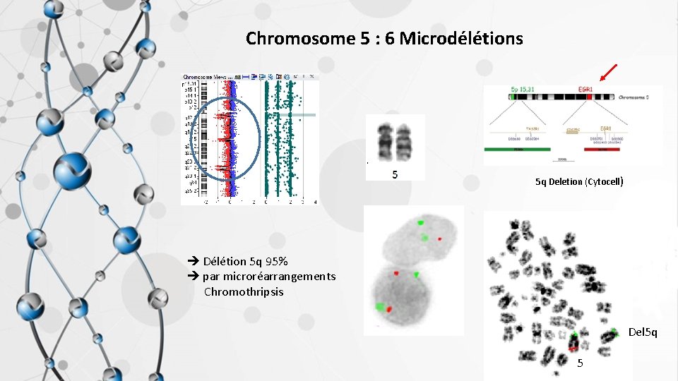 Chromosome 5 : 6 Microdélétions 5 q Deletion (Cytocell) è Délétion 5 q 95%