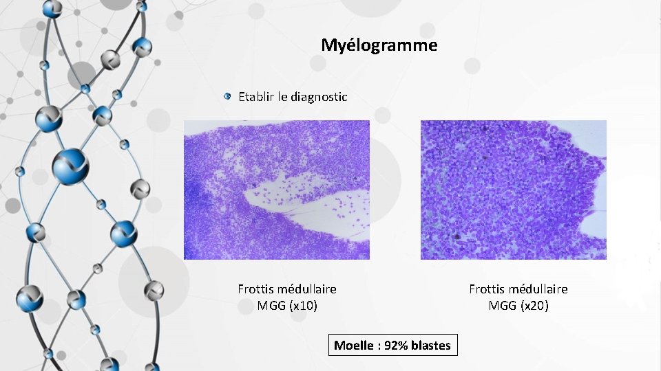 Myélogramme Etablir le diagnostic Frottis médullaire MGG (x 10) Moelle : 92% blastes Frottis