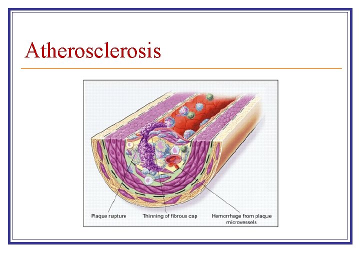 Atherosclerosis Atherosclerosis
