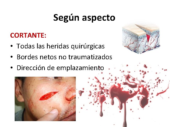 Según aspecto CORTANTE: • Todas las heridas quirúrgicas • Bordes netos no traumatizados •