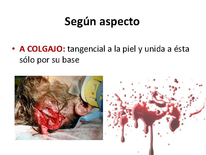Según aspecto • A COLGAJO: tangencial a la piel y unida a ésta sólo