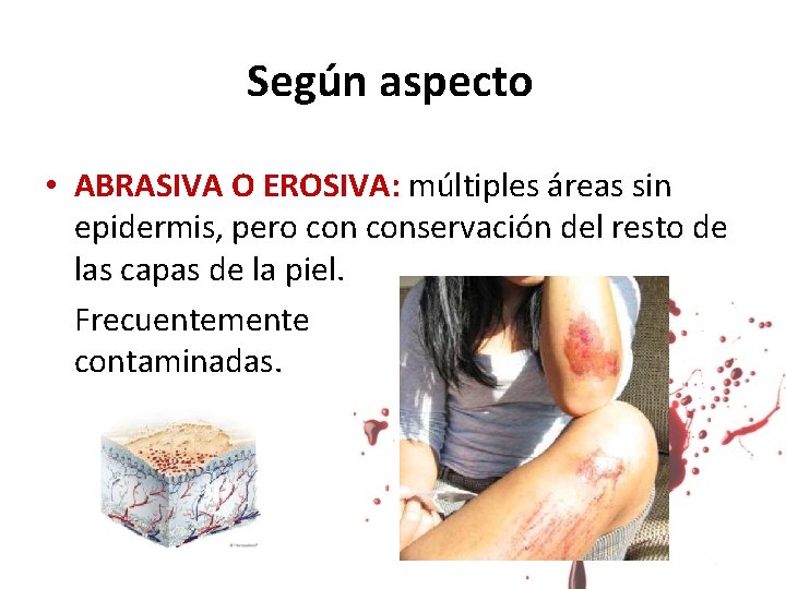 Según aspecto • ABRASIVA O EROSIVA: múltiples áreas sin epidermis, pero conservación del resto